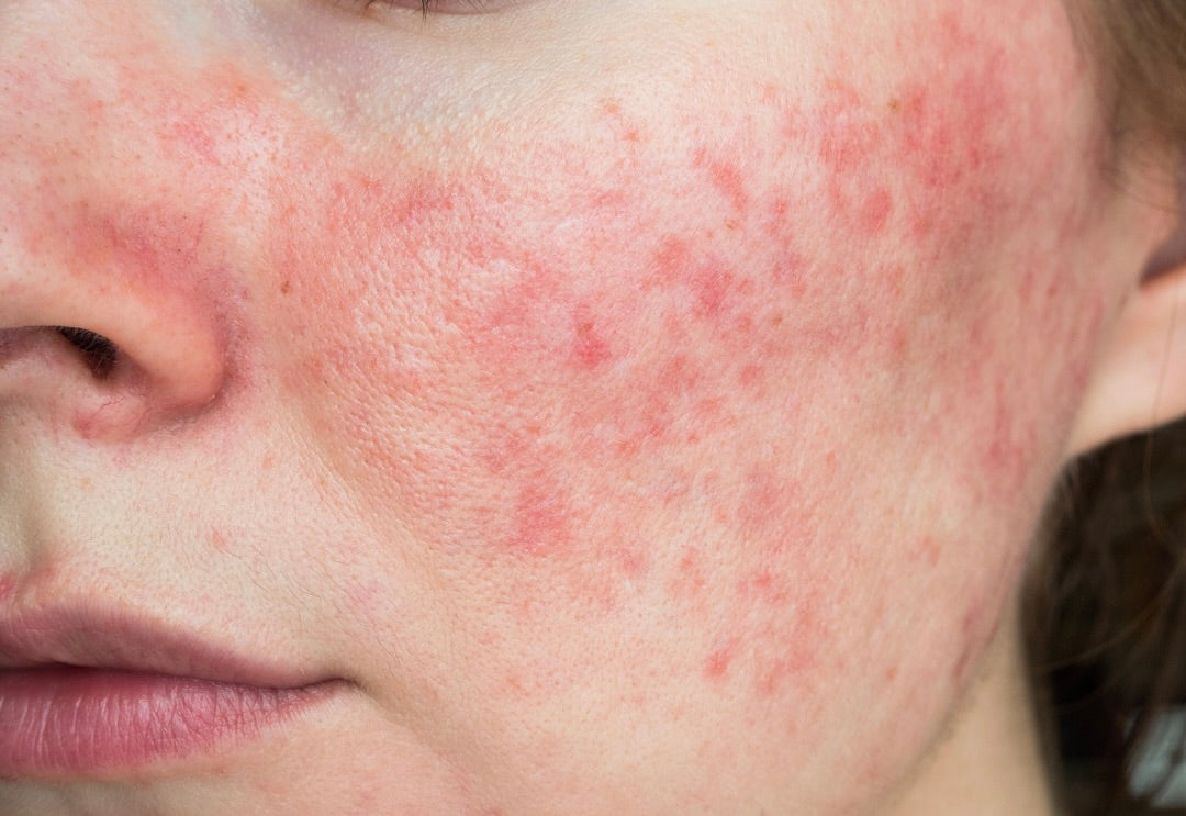 What is Rosacea?